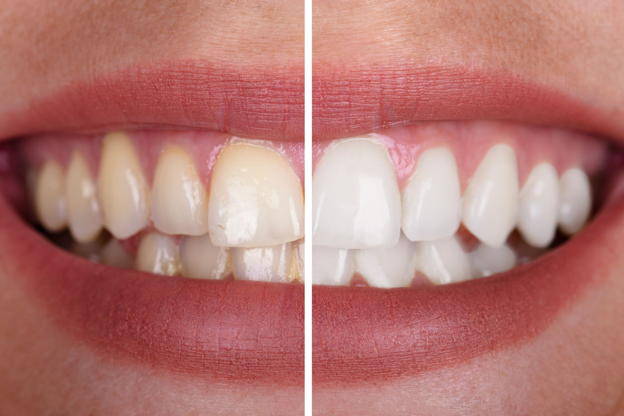 wat je moet weten over tanden of bleachen | GlamSmile