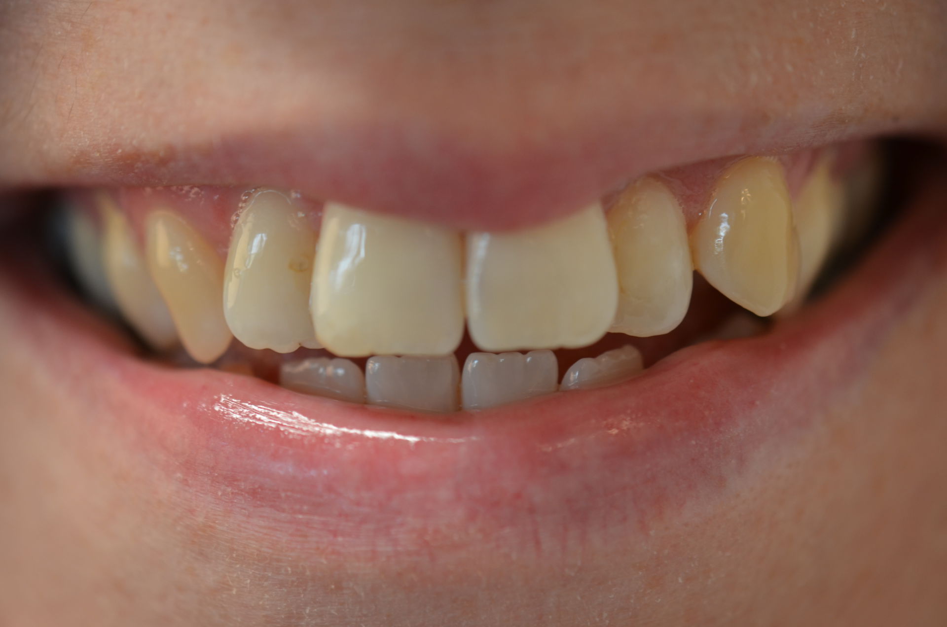 Bijproduct Helemaal droog schrobben Rechte tanden zonder beugel? Het kan! | GlamSmile