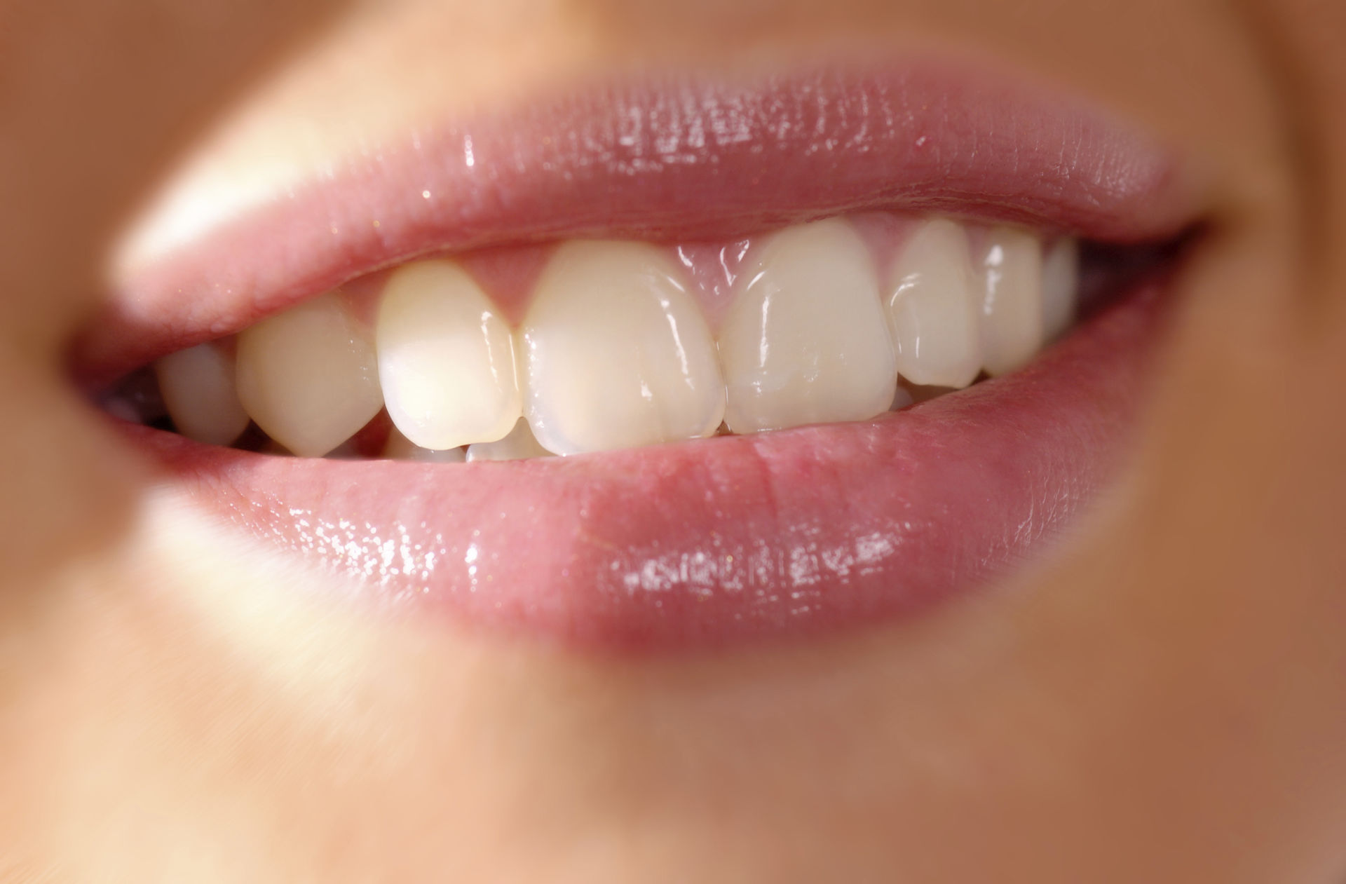 Bloody menu waardigheid Bleaching: laat jij je tanden bleken? | GlamSmile